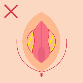 対象外箇所小陰唇周辺