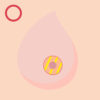 乳輪(乳頭は照射対象外)